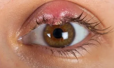 İri gözler tiroit hastalığı habercisi olabiliyor!