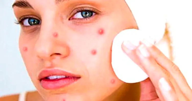 Sivilce nasıl geçer? Neden sivilce olur? Sivilce nasıl temizlenmeli?