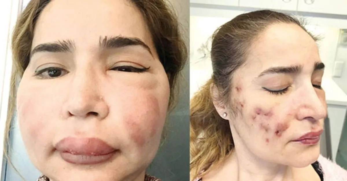 Estetik Yaptirmak Istedi Taninmayacak Hale Geldi Galeri Turkiye