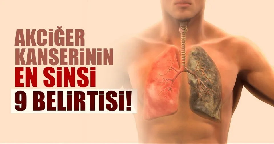 Akciger Kanserinin En Sinsi 9 Belirtisi Saglik Haberleri