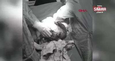Kahramanmaraş’ta kadın hastanın karnından çıkan 9 kilo 600 gram ağırlığında dev tümör kamerada