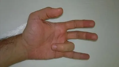 Tetik parmak hastalığı nedir? Tetik parmak hastalığının belirtileri...