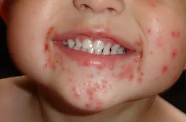 Cocuklarda El Ayak Agiz Hastaligina Dikkat Sabah