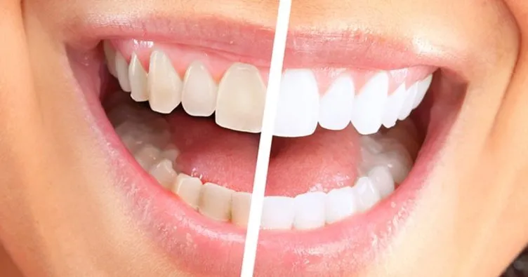 Diş beyazlatma hakkında merak ettikleriniz!