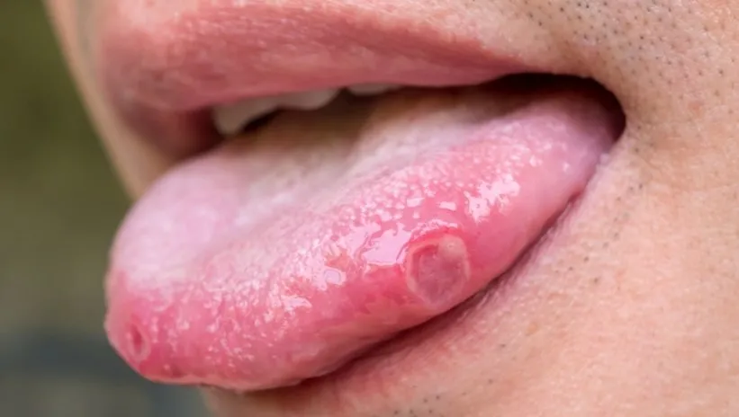 Basit bir aft sandığı dilindeki yara kanser çıktı! Uzmanlar uyarıyor: Bu kanser türü 10 yılda %46 arttı