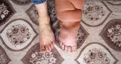 Milyonda bir görülen hastalığa yakalandı: Bacakları her yıl 7 santimetre genişliyor!