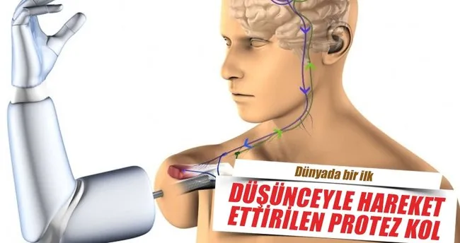 Dusunceyle Kontrol Edilen Ilk Protez Kol Saglik Haberleri
