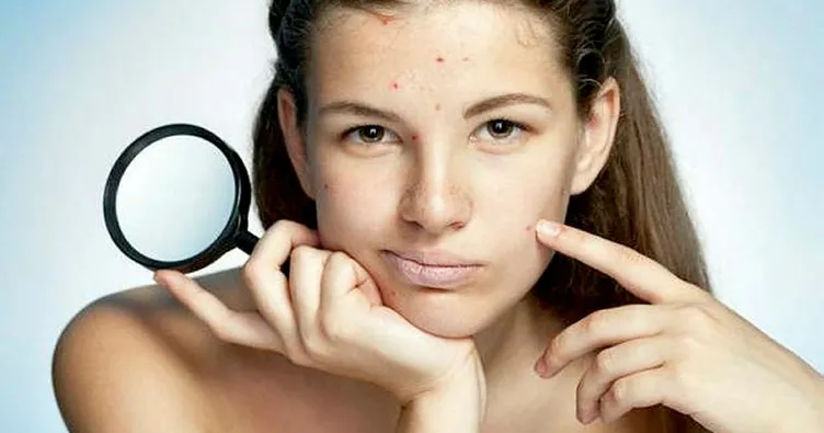 Fazla yağ tüketimi sivilce yapıyor