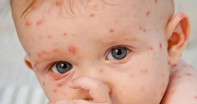 Sucicegine Ne Iyi Gelir Ve Nasil Gecer Dogal Ve Bitkisel Yontemlerle Sucicegi Tedavisi Nasil Yapilir Son Dakika Haberler