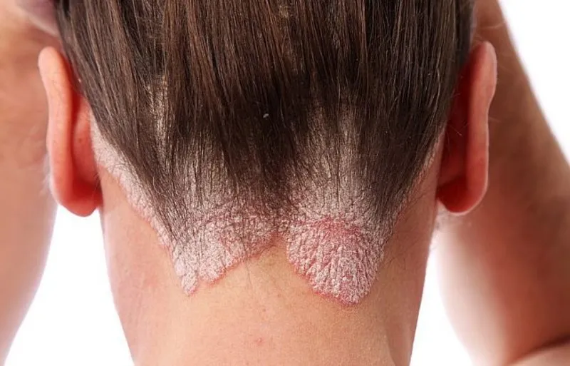 sedef hastaligi belirtileri nelerdir