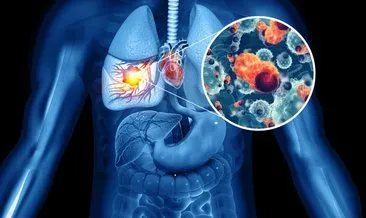 İki haftayı geçen öksürüklerin akciğer kanseri belirtisi olabileceği uyarısı
