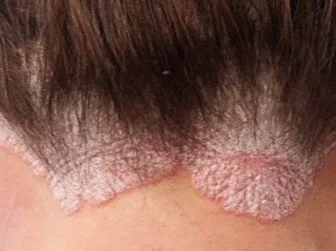 sac derisinde kabuklanma neden olur sayfa 2 saglik haberleri