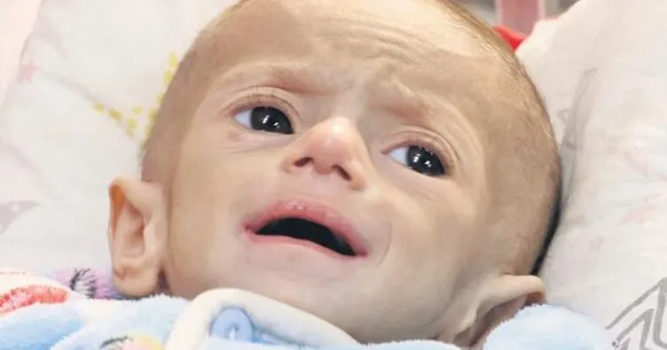 Çocuklar açlıktan gözlerini kaybediyor