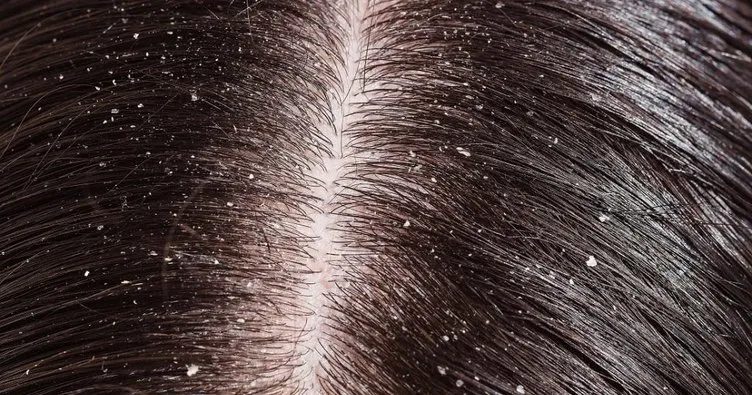 Saç neden kepeklenir? Saç kepeklenmesi doğal ve bitkisel yollardan nasıl geçer?