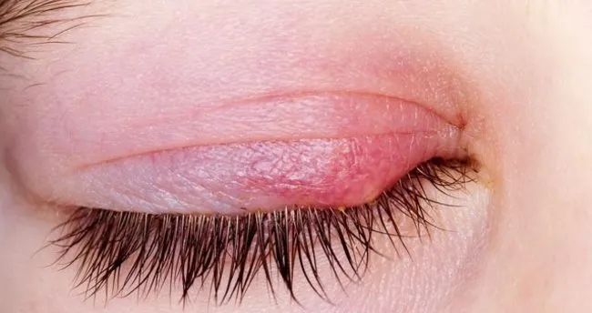 gozde cikan arpacigi gecirmenin en hizli ve dogal yolu kadin haberleri