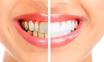 Diş Taşı Temizliği Fiyatı-Diş Temizleme Fiyatları Ne Kadar, Kaç Seans Sürer?