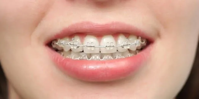 Diş teli tedavisi ile ilgili doğru bilinen 5 yanlış