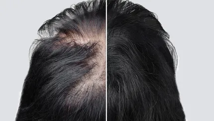 Saçlarınızın önü seyrekse bu yöntemi mutlaka deneyin! Soğan suyu, yeşil çay... - Yaşam Haberleri