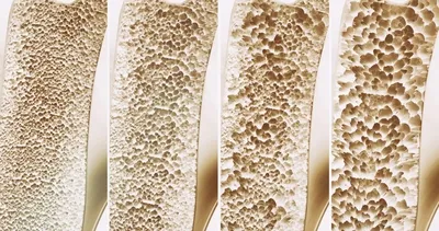 Günlük hayatta yaptığımız bu hata kemik erimesine neden oluyor! İşte osteoporozun nedenleri