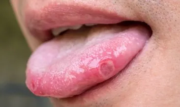 Basit bir aft sandığı dilindeki yara kanser çıktı! Uzmanlar uyarıyor: Bu kanser türü 10 yılda %46 arttı