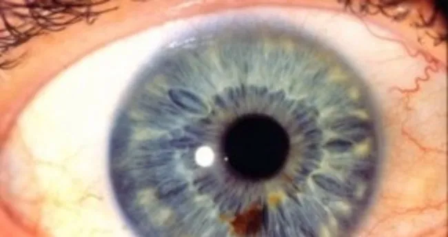 gozbebegi iltihabi nedir belirtileri nelerdir saglik haberleri