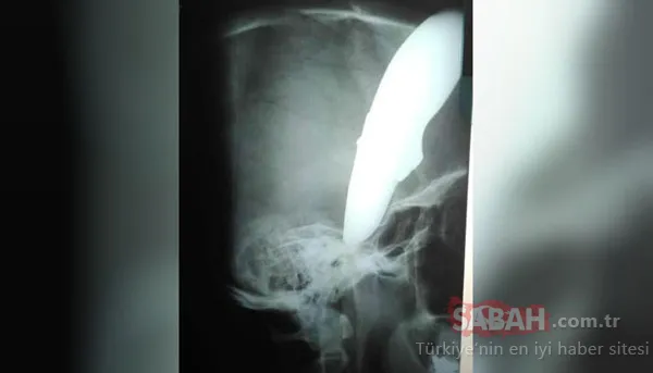 Başına saplanmış 15 cm'lik bıçakla kurtuldu!