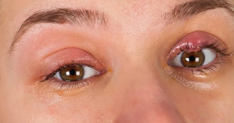 Arpacığa Ne İyi Gelir? Gözde Çıkan Arpacık En Hızlı Nasıl Geçer?