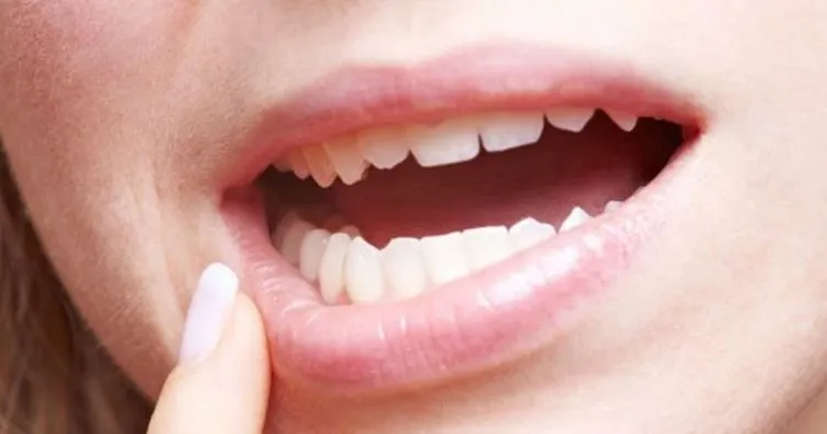 Apseli dişe ne iyi gelir? Apseli diş çekilir mi, çekilirse ne olur? Apseli diş ağrısı nasıl geçer?