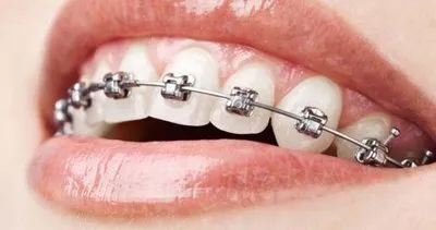 Diş teli tedavisinde doğru bilinen 7 yanlış