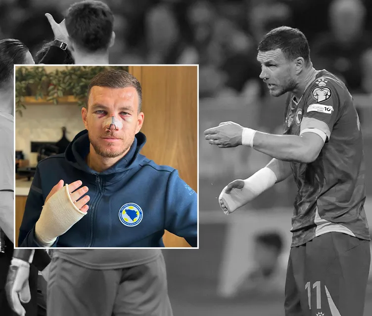 Son dakika haberi: Burnu kırılan Edin Dzeko son halini paylaştı! İşte sahalara dönüş tarihi...