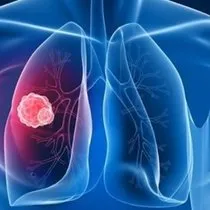 Akciger Lekesi Nedir Belirtileri Nelerdir Gercek Gundem