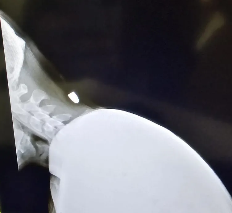 Yorgun mermi molada yakaladı: Şah damarına tam 2 santim!