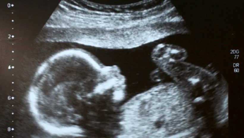 Bilim dünyası şokta! 30 milyonda bir görülüyor: Cinsel organı olmadan doğan bebek…