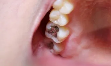 Çürük dişleri tedavi ettiği ortaya çıktı!