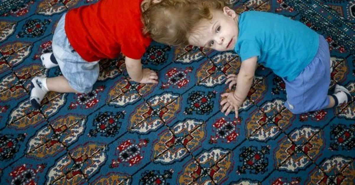 siyam ikizleri bir yasina girdi