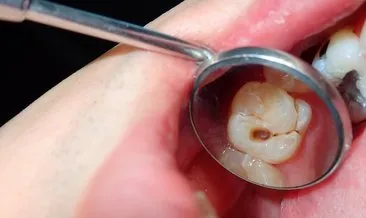 Neden Dişlerimizi erken yaşta kaybediyoruz?