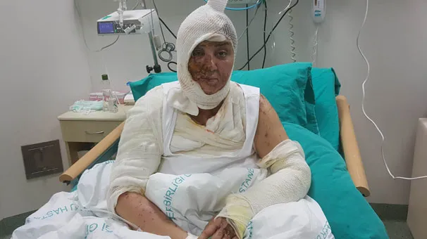 Tecavüz etmek istediği Azeri kadını kezzap ile yaktı