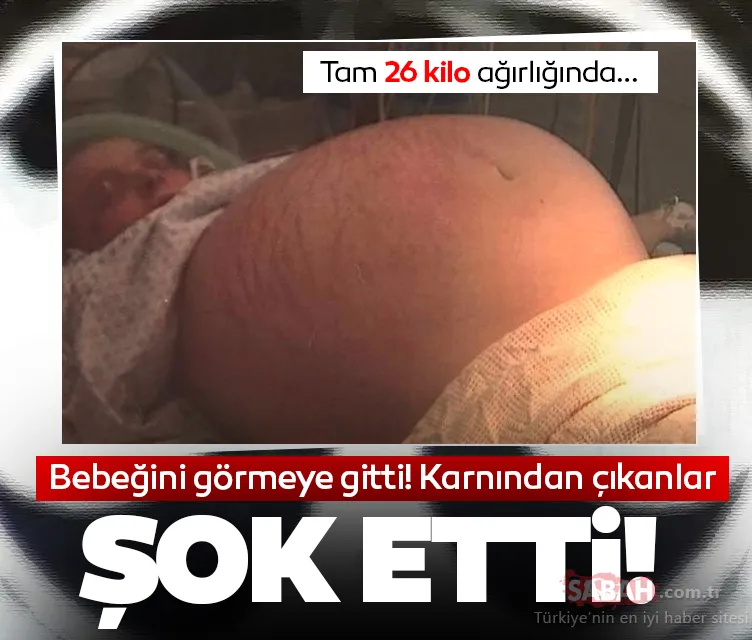 Doktorlar bile şok oldu! Bebeğini görmek için hastaneye gitti, karnından tam 26 kilo ağırlığında…