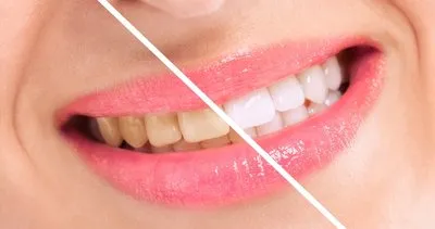 20 dakikada diş beyazlatma yöntemine çok şaşıracaksınız!