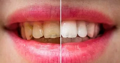 Bu doğal yöntem sayesinde dişleriniz bembeyaz olacak!