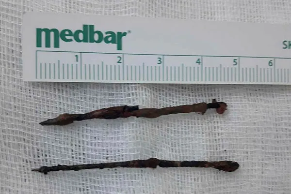 Vücudundan çıkan çuvaldızlar, doktorları Åoke etti