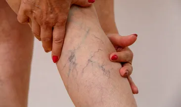 Bacaklar neden damar tıkanır?