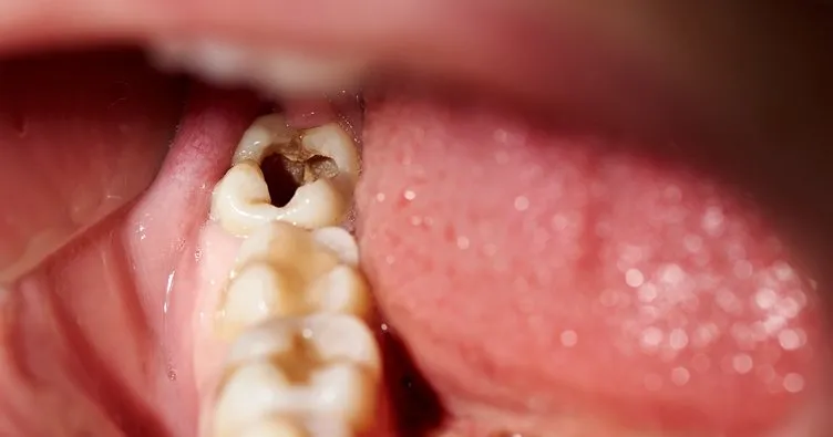 ’’Çürük dişler bu hastalıklara yol açabilir!