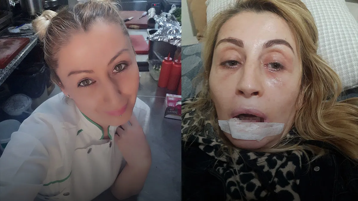 Antalya’da estetik faciası: İşlem sonrası dudağı çürüdü! ‘Gülüşüm yok’ Antalya’da estetik faciası: İşlem sonrası dudağı çürüdü! ‘Gülüşüm yok’