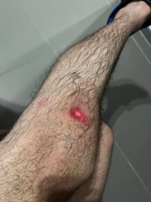 Okula giden 16 yaşındaki İhsan köpek saldırısına uğradı: Talihsiz çocuk canını zor kurtardı!