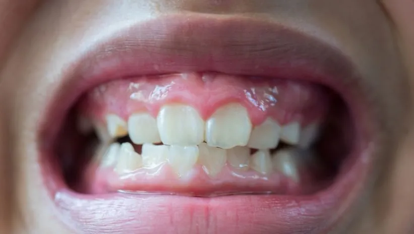 Uzmanı anlattı: Günde 3 defadan fazlası diş erozyonunu 37 kat artırıyor!