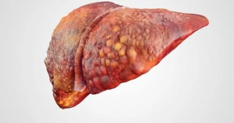 Karaciğer yağlanması belirtileri nelerdir? Tedavisi nasıl yapılır, ne kadar  sürede geçer? - Sağlık Haberleri