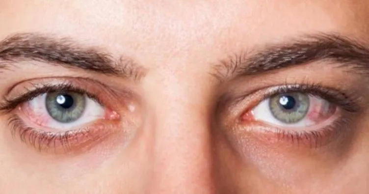Göz enfeksiyonu nedir? Nasıl tedavi edilir?