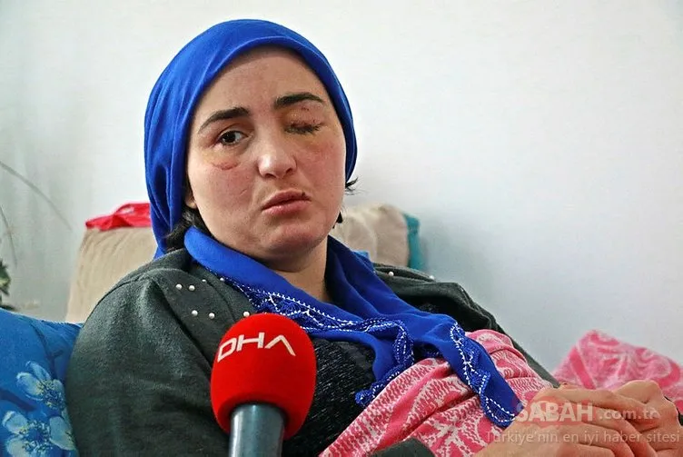 Son dakika haberi Eşinin şiddeti yüzünden gözünü kaybetti Son dakika haberi Eşinin şiddeti yüzünden gözünü kaybetti