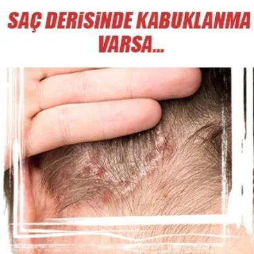 Sac Derisinde Kabuklanma Neden Olur Sanal Basin